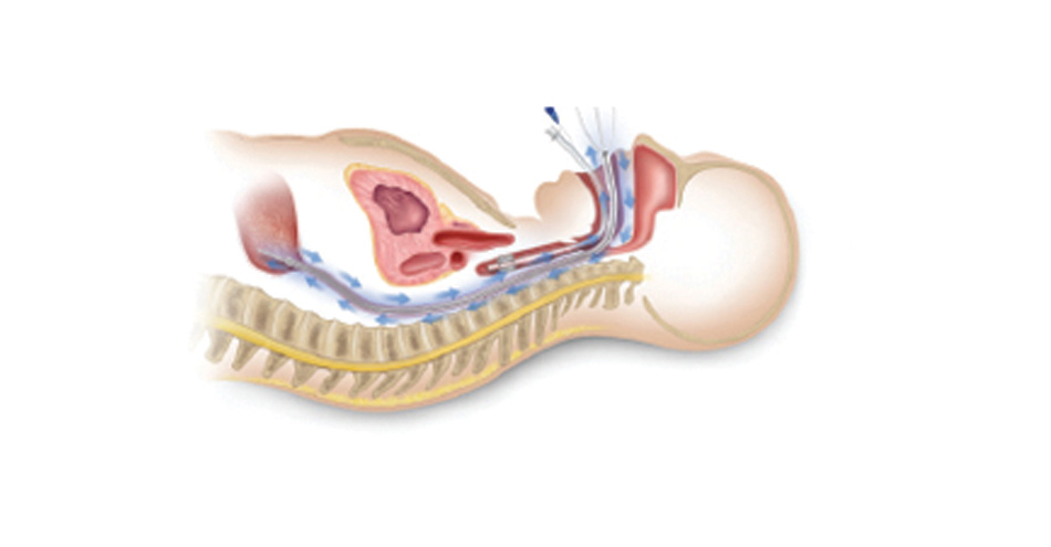 Esophageal Cooling Device Shows Benefits in Heat Conduction