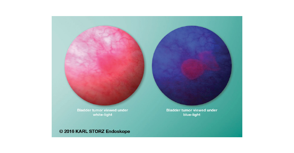 KARL STORZ Receives Innovative Technology Designation for Blue Light Cystoscopy
