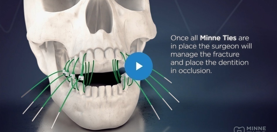 Minne Ties Agile MMF Wins 2018 Medical Design Excellence Award