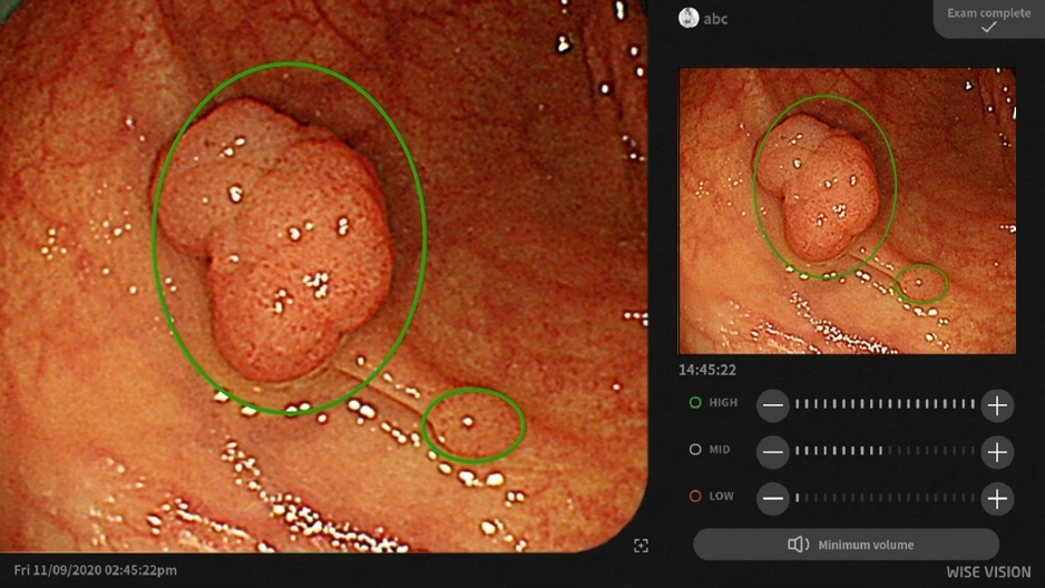 WISE VISION Endoscopy Graphic 2