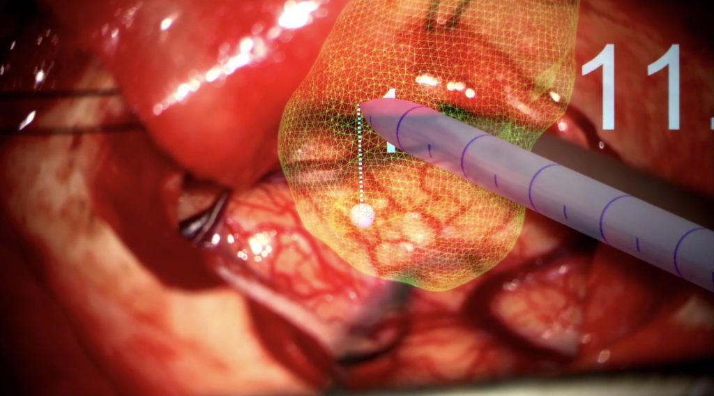 Medtronic and Surgical Theater Create Augmented Reality Platform