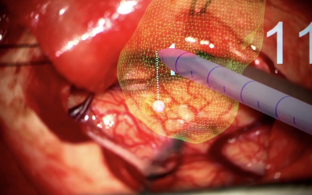 Medtronic and Surgical Theater Create Augmented Reality Platform