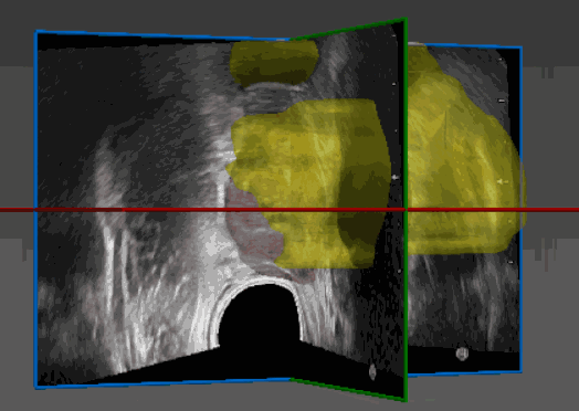 RSIP Vision Launches Advanced AI-Based Tool for Prostate MRI and Ultrasound Registration
