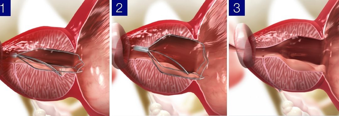 Olympus Acquires Israeli Medical Device Company Medi-Tate to Drive Global Urology Business Growth