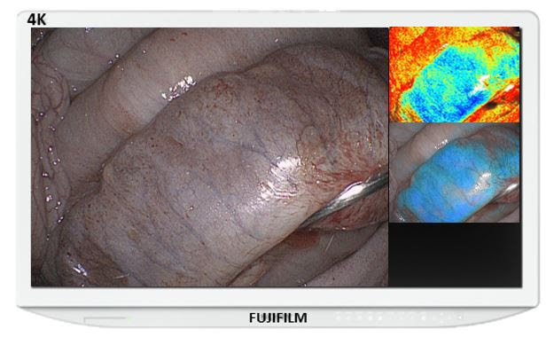 FDA Grants 510(k) Clearance for Fujifilm’s New Endosurgical Image Enhancement Technology