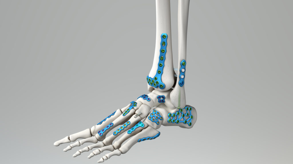 Medline UNITE Launches Calcaneal Fracture Plating System and IM Fibula Implant