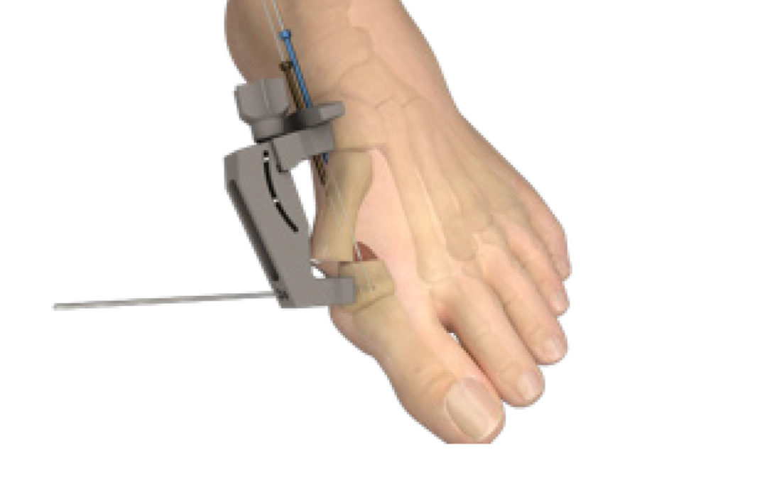 Stryker PROstep MICA SOLO Guide