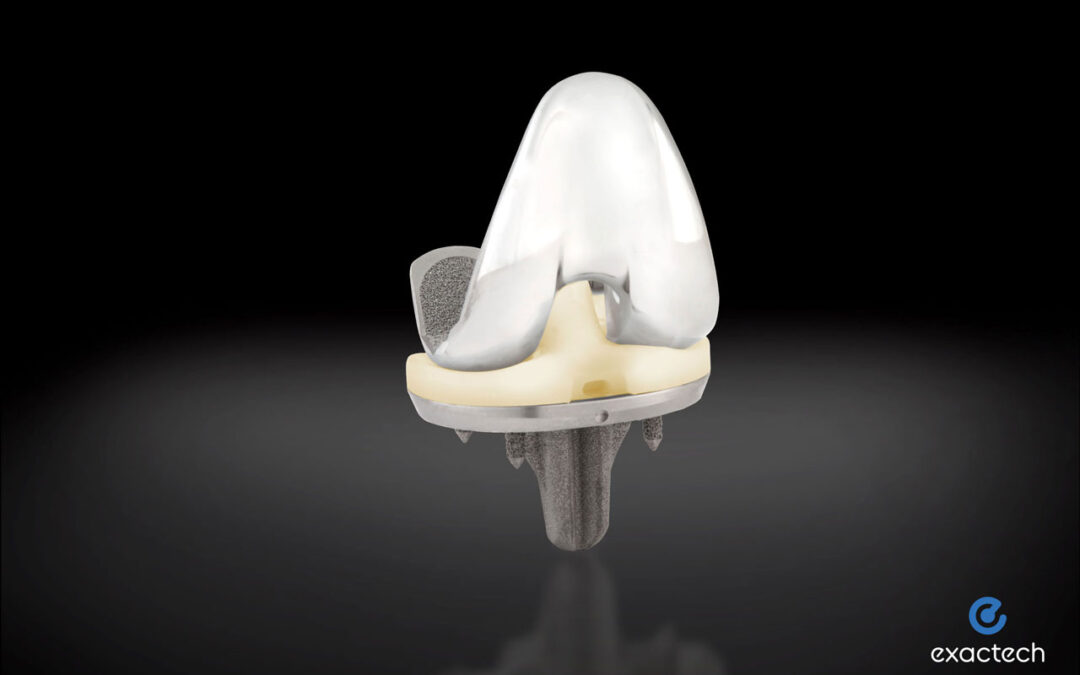 Exactech Announces First Surgeries Using Activit-E for Knee Replacement