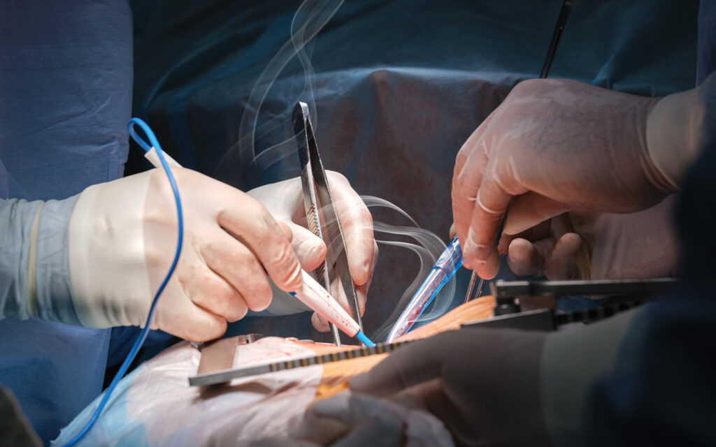 Surgical Smoke Legislation Update