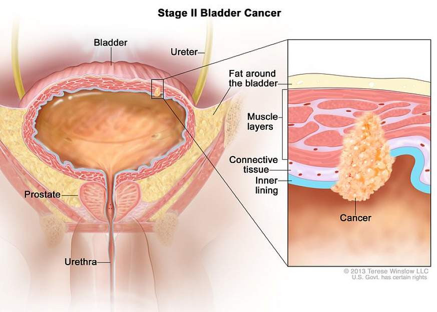 Immunotherapy after surgery helps people with high-risk bladder cancer live cancer-free longer
