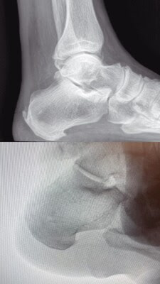 NEWPORT NEWS FOOT & ANKLE SURGEON PERFORMS FIRST MINIMALLY INVASIVE HAGLUND’S REPAIR ON THE PENINSULA