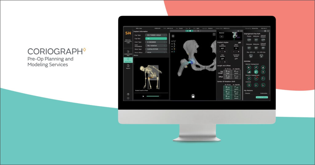 Smith+Nephew introduces CORIOGRAPH Pre-Op Planning and Modeling Services for Total Hip Arthroplasty