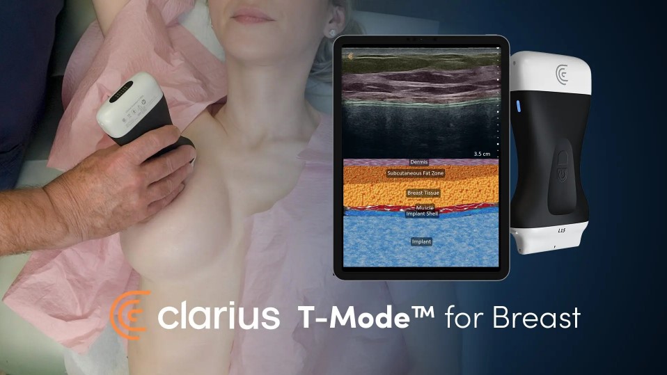 AI-Powered Ultrasound Helps Plastic Surgeons Master Ultrasound Breast Anatomy for In-Clinic Exams
