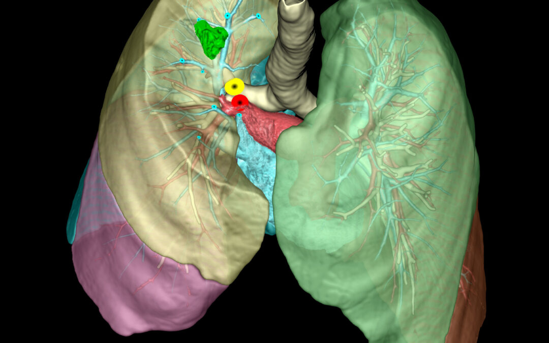 Olympus, Ziosoft Launch of AI-Powered Surgical Planning Tool