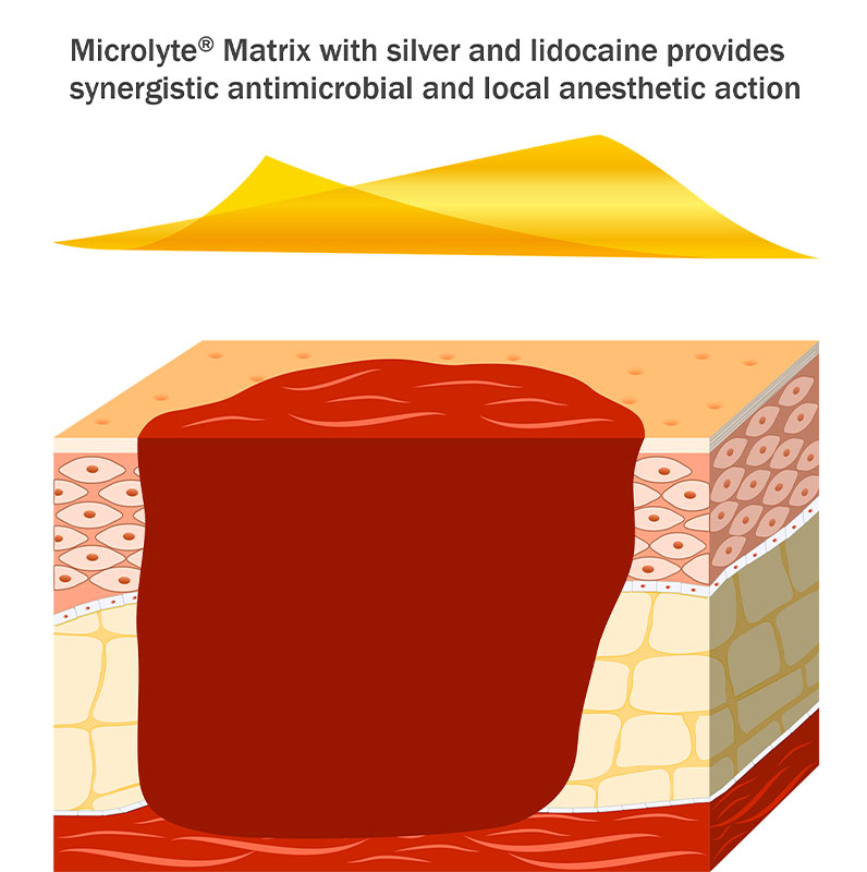 Imbed Biosciences Microlyte Ag/Lidocaine