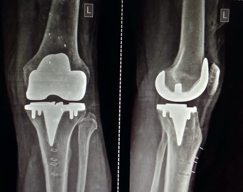 Monogram Technologies Announces World’s First Fully Autonomous Saw-Based Robotic Knee Replacement Surgery