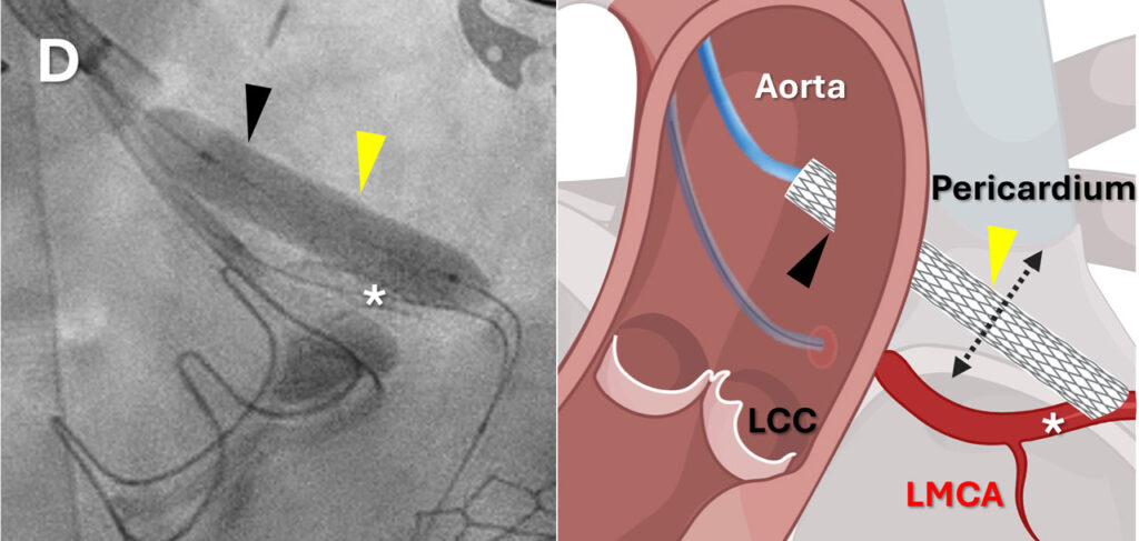 Researchers Achieve First Minimally Invasive Coronary Artery Bypass