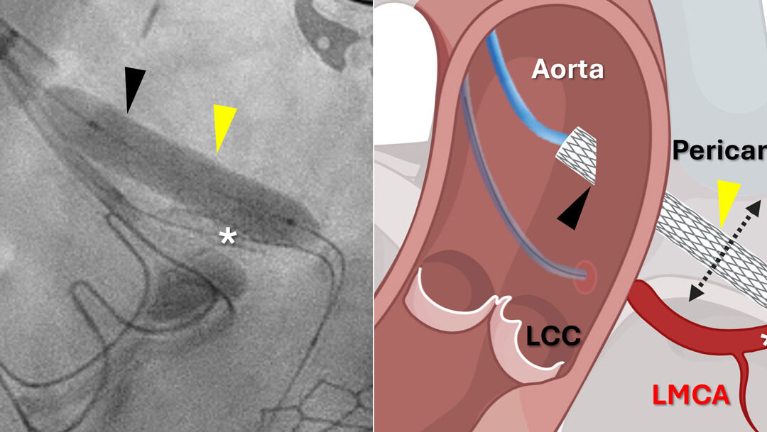 Researchers Achieve First Minimally Invasive Coronary Artery Bypass