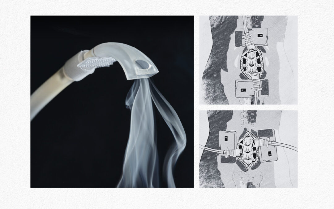 Operating Room Innovations SmokeStop