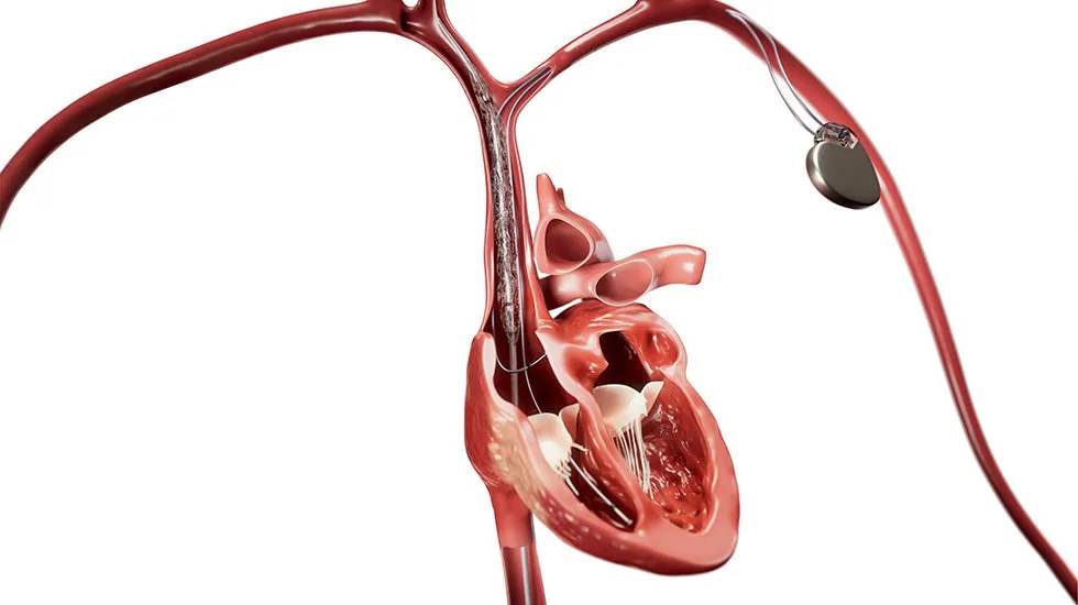 Bridge Plus Occlusion Balloon Helps ManageLife-Threatening SVC Tears