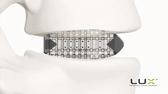 Xenix Medical Announces FDA Clearance and Full Commercial Launch of the Lux Expandable Lumbar Interbody Fusion System