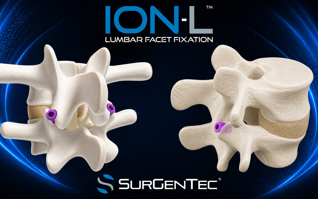 Novel Lumbar Facet Fixation System Receives FDA Clearance